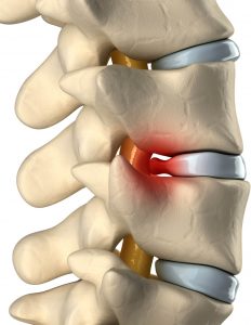 What Is A Herniated Disc Herniated Disc Symptoms