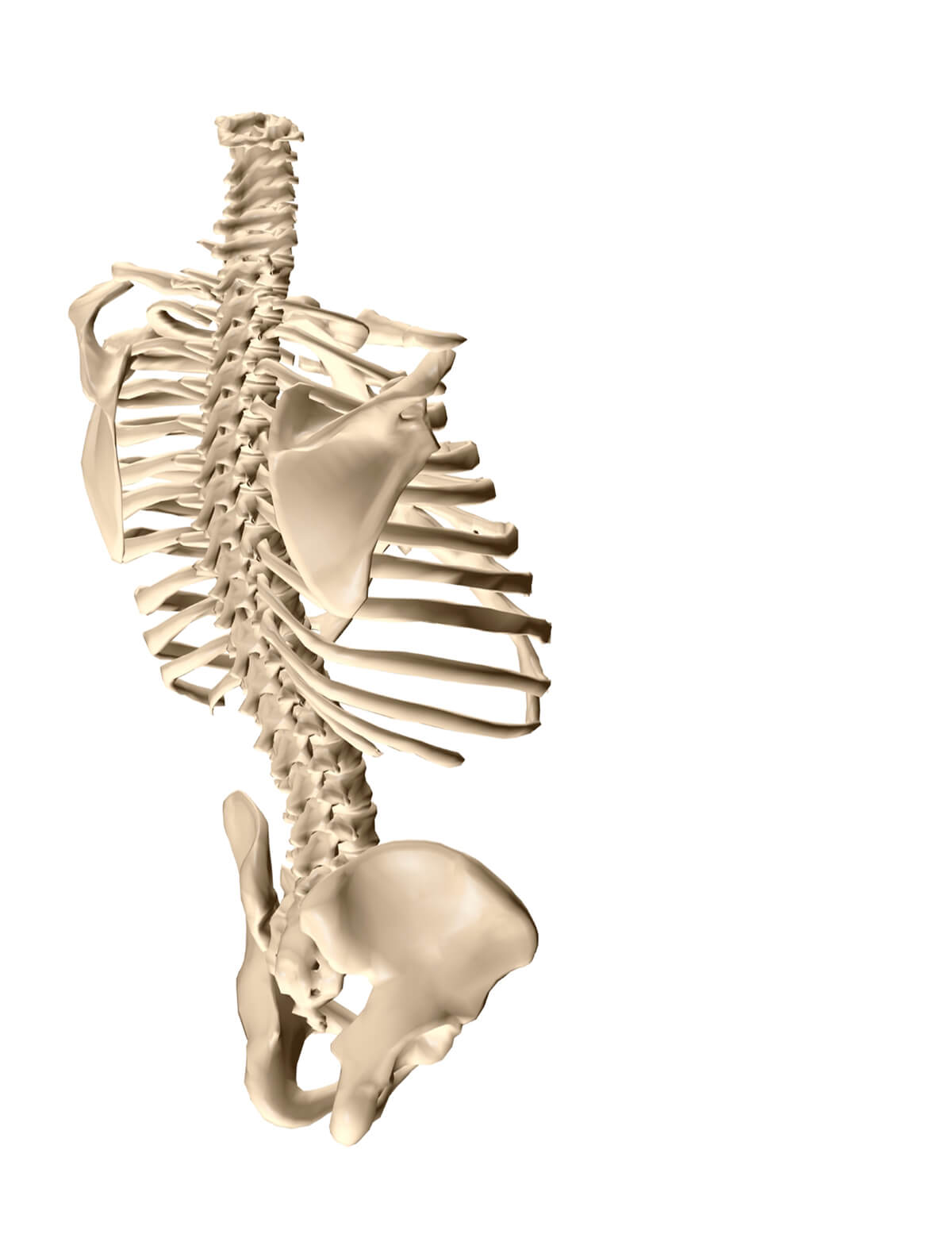 What Causes Scoliosis